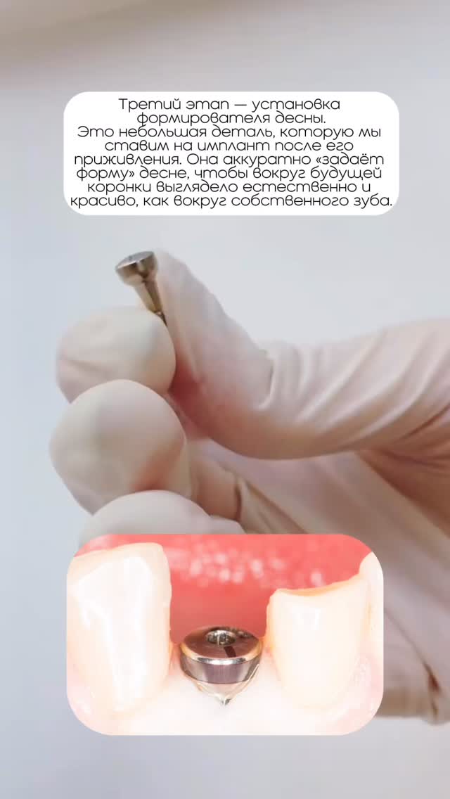 Имплантация случай