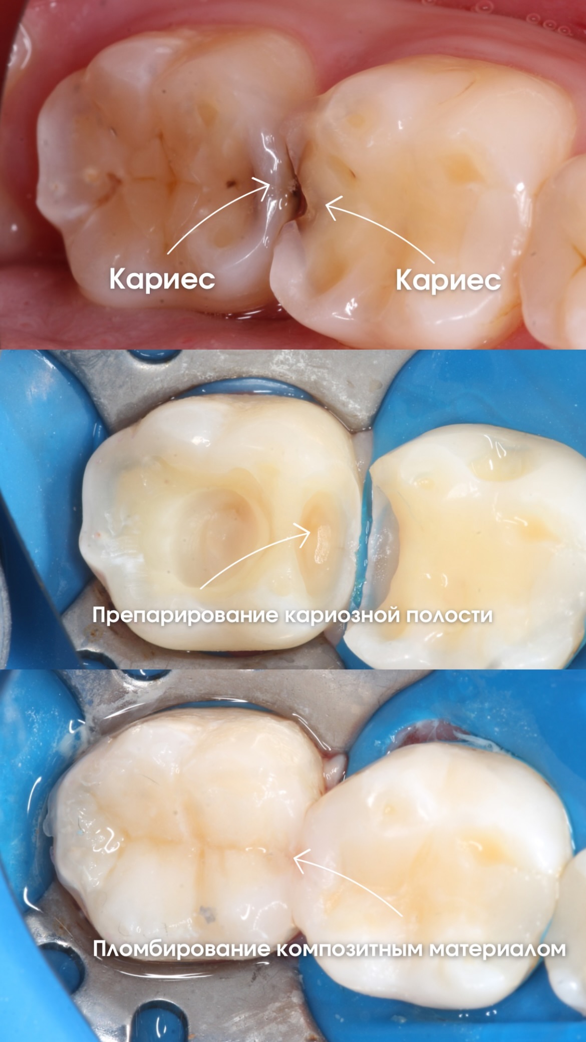 До и после билдап