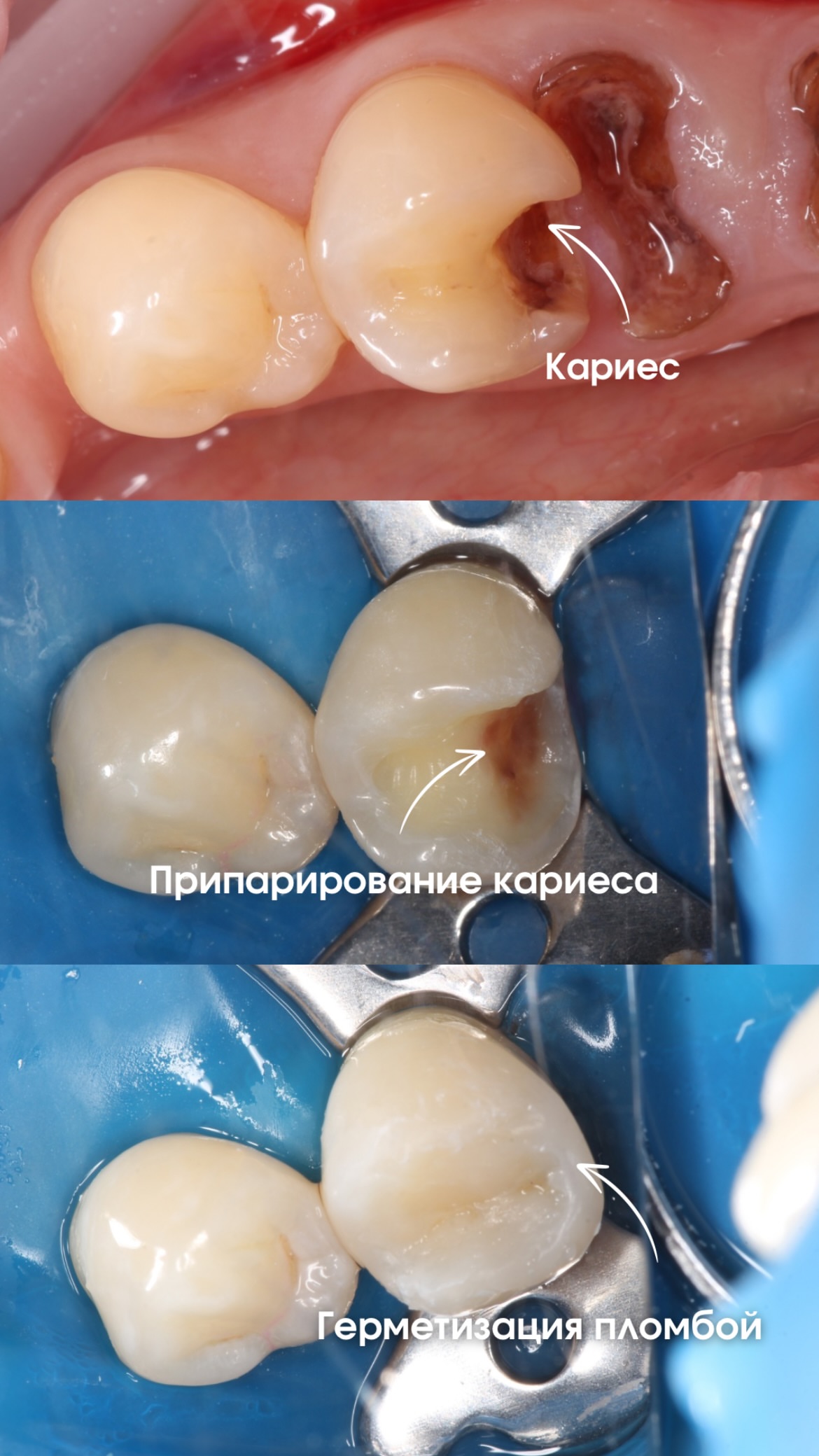 До и после клиновидный дефект