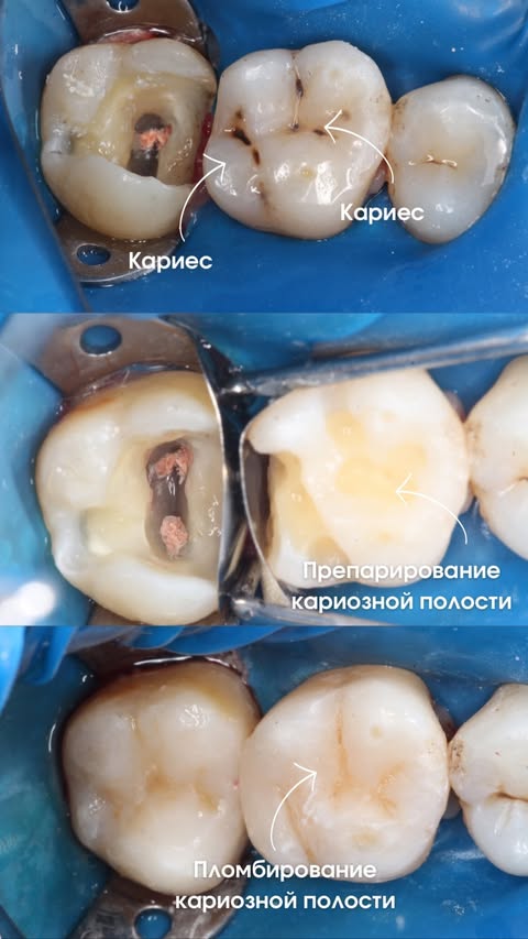 До и после: восстановление зуба