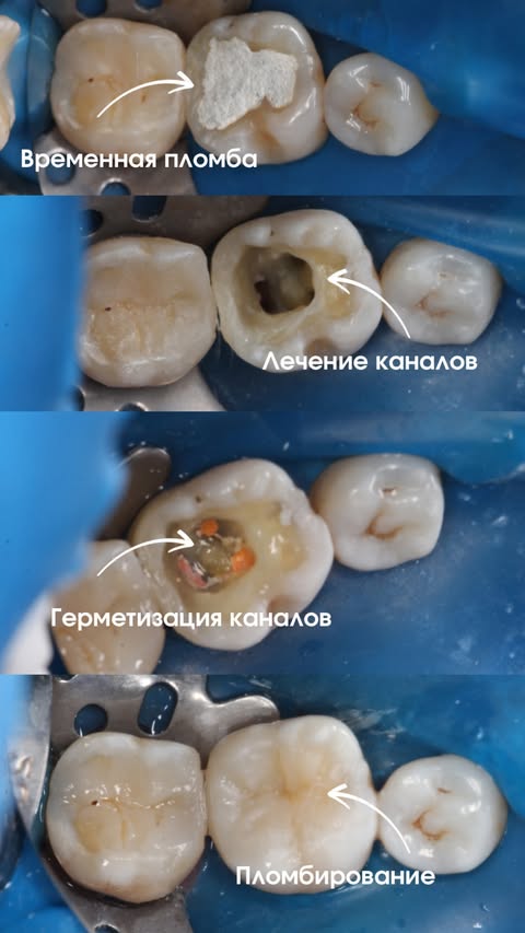 До и после: восстановление кариозного разрушения