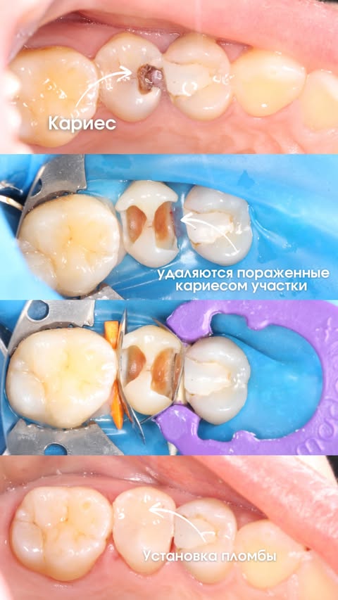 До и после: керамическая вкладка