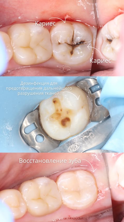 До и после: макро-кариес