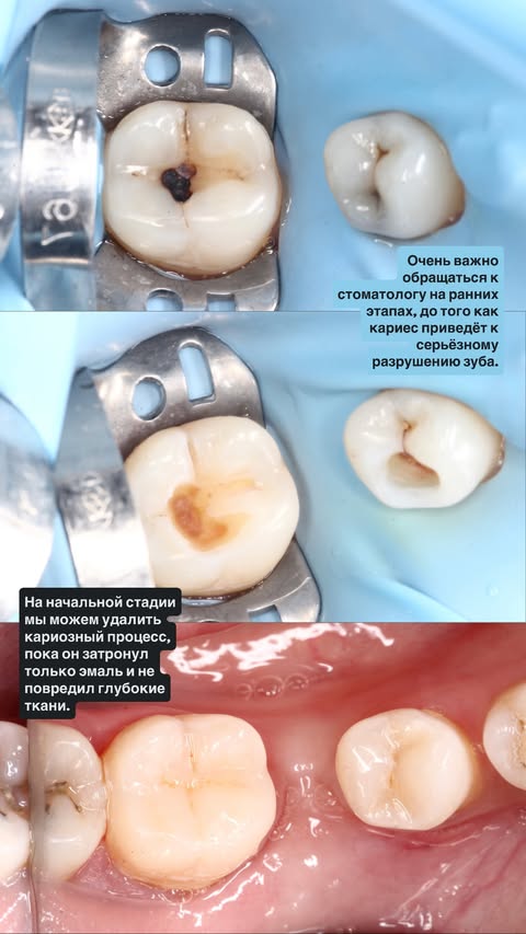 До и после: множественные реставрации
